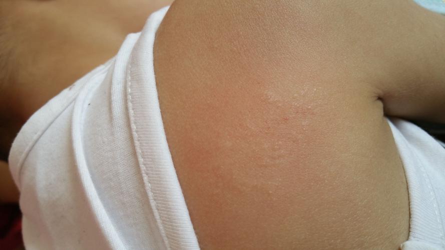 三岁宝宝后背,请问这是什么?不疼不痒的