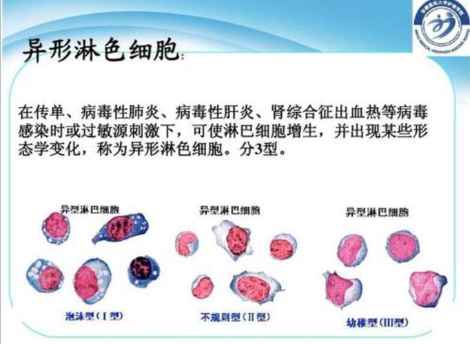 异型淋巴细胞图谱