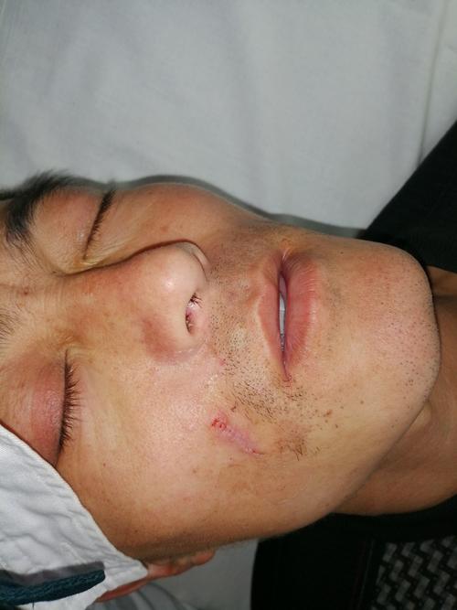 这是微创手术,面部囊肿拆线后的这是普通外科缝合,粗针大线,想想孩子