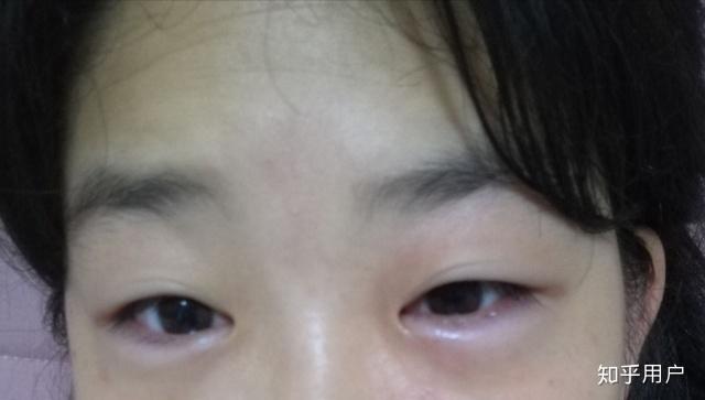 你是否有这种误区:眼浮肿就是肾病?看看还有哪些习惯导致眼浮肿