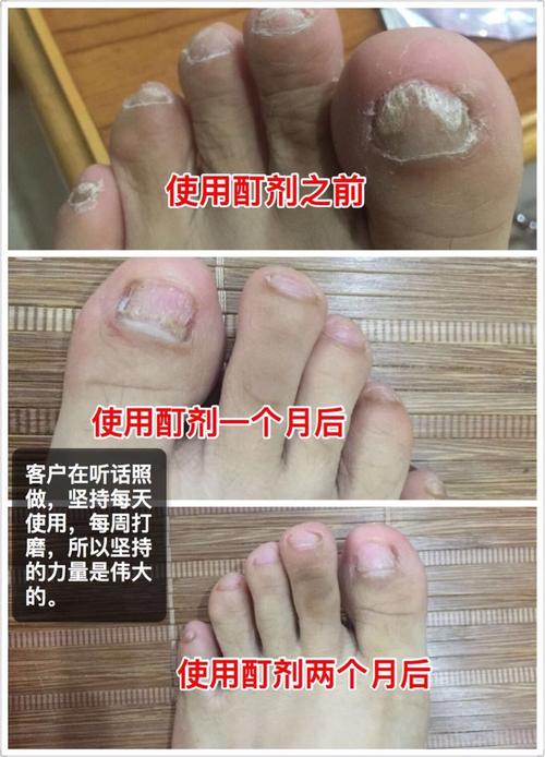 客户使用亮甲没效果,最终购买柏多蒂,使用一个月,两个