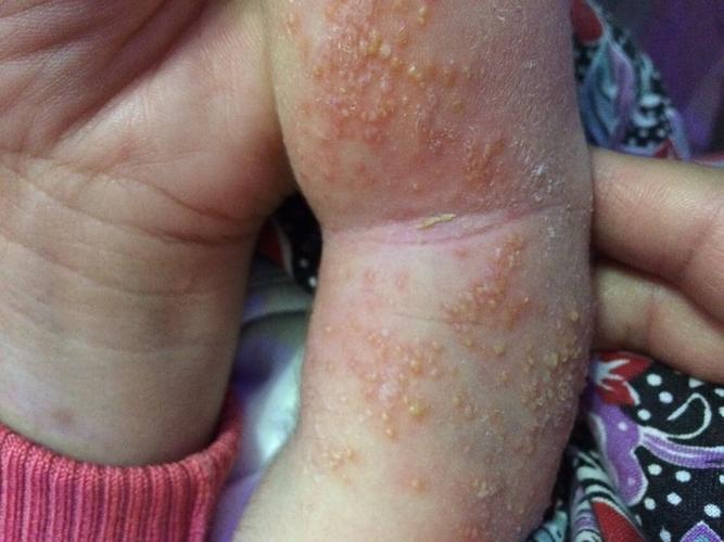 幼儿皮肤起水泡 不知道什么原因 谢谢回答