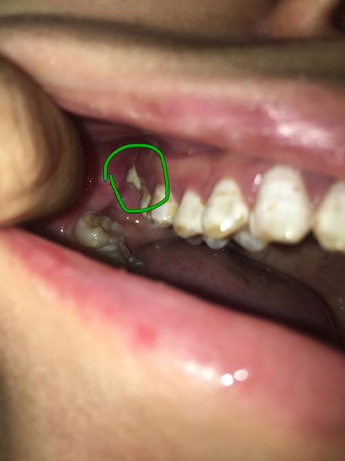 医生说我的牙齿不好,去年才发现牙龈上面长了智齿