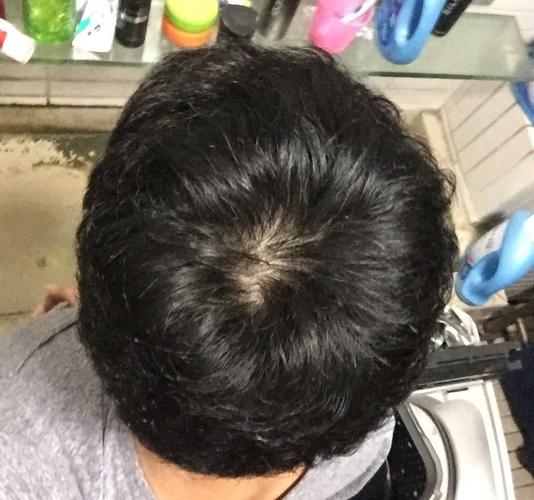 请问这算是头顶脱发吗?