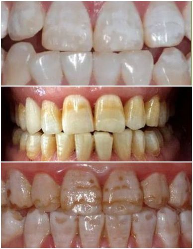 儿童会得氟斑牙吗?