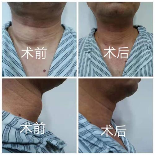查出甲状腺结节一定要手术?先做穿刺再决定