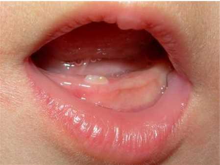 宝宝没长牙可牙床却是肿胀的呈青紫色是不是牙齿坏在里面