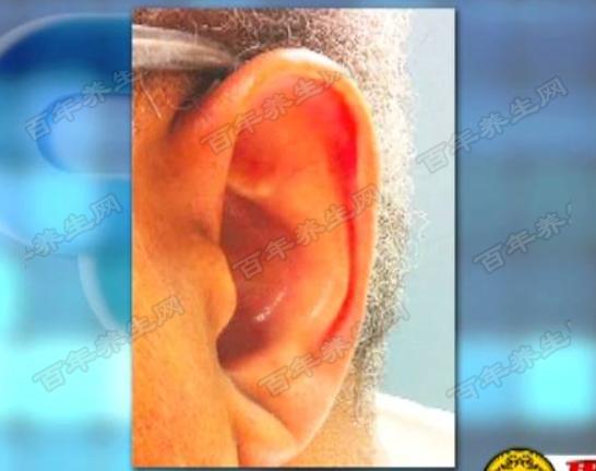 当心肌供血不足以后,耳朵,耳垂上皮下组织的供血也就不足了,之后就会