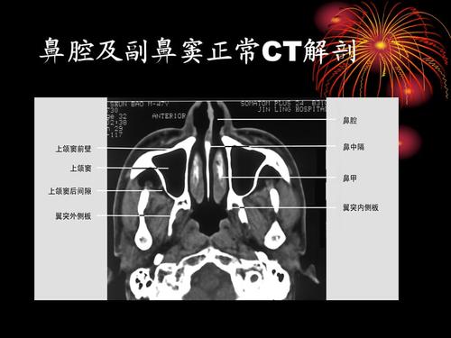 鼻和鼻窦病变ct诊断.ppt