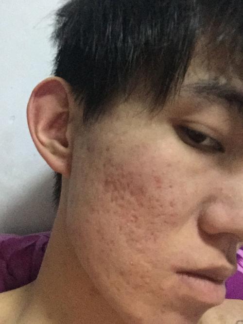 这痘坑痘印该怎么祛除.最后快速的