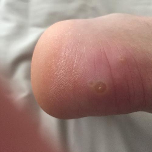 在脚后跟长的,按压有点疼,是鸡眼嘛