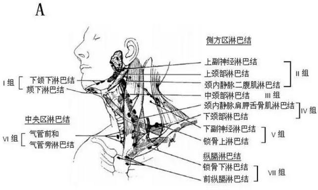 手术攻略:髓样甲状腺癌伴淋巴结转移