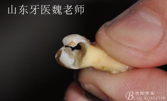 微创洞穿智齿分牙的革命