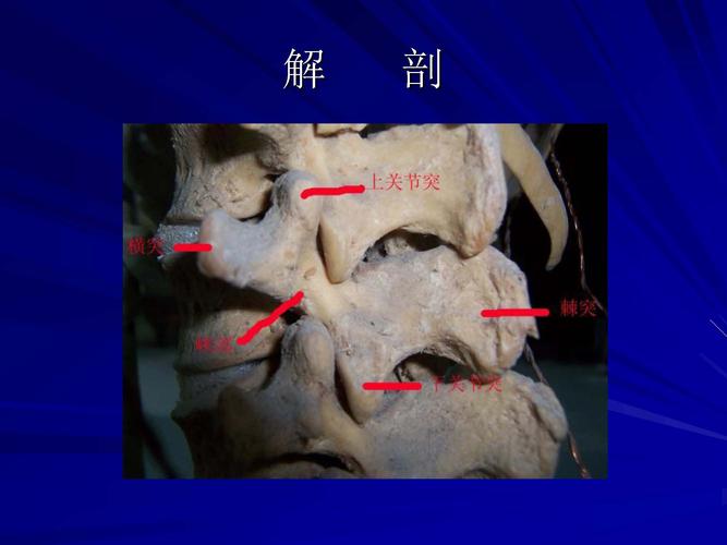 椎弓根螺丝钉棘突钢丝系统治疗青年性腰椎椎弓峡部裂