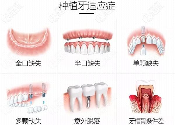 这有它的半口种植牙视频演示过程及原理呦