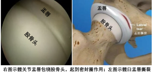 什么情况容易造成髋关节盂唇撕裂?