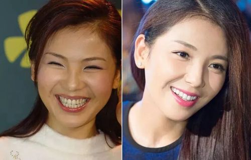 刘涛牙齿变白以后,颜值气质都跟着提升了不少, 彻底摆脱了土里 土气