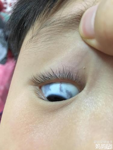 大宝眼白里有黑斑
