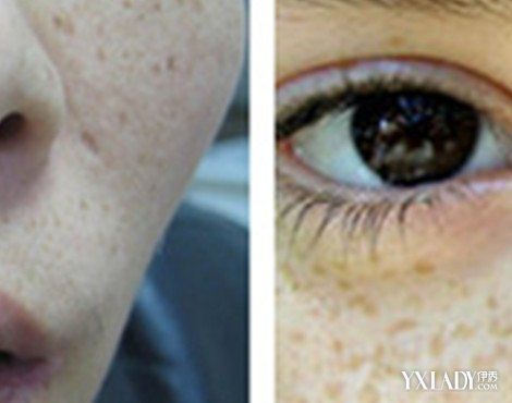 【图】黄褐斑与雀斑对比图分析 为你介绍这两种症状的区别和相同点