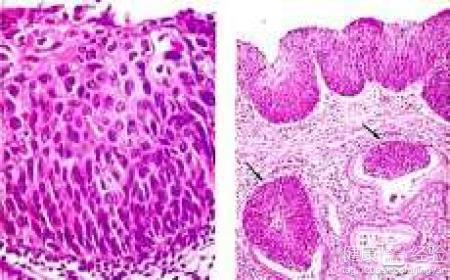 乳腺导管原位癌膀胱癌的手术治疗