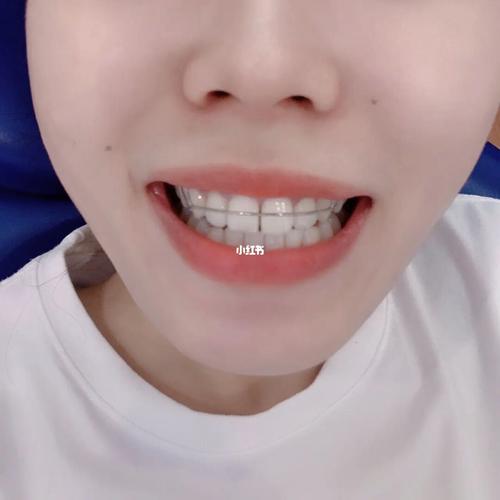 保持器_牙套_牙医_磨牙