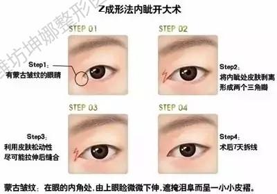 开内眼角你适合吗