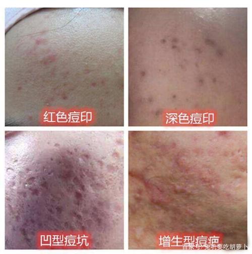 毛细血管膨胀 深色痘印:黑色素的沉淀以及堆积导致痘印颜色加深 痘坑