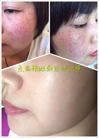 美容——点斑祛痣
