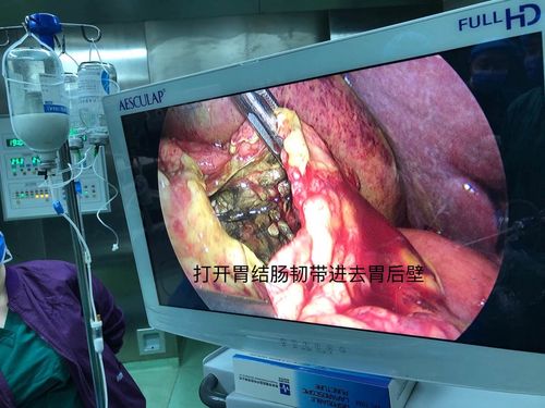 普外科微创治疗胃穿孔(胃后壁穿孔)