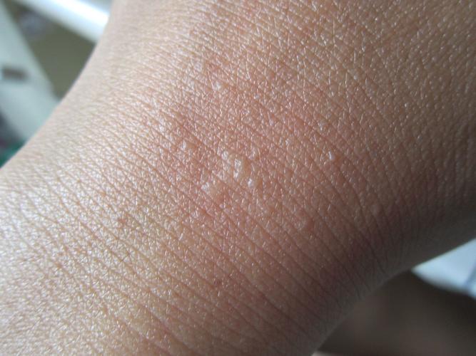 手背上和手指间长了白色的小水泡,手腕上也有两个