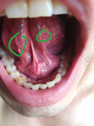 口腔,舌头底下长了几个肉疙瘩