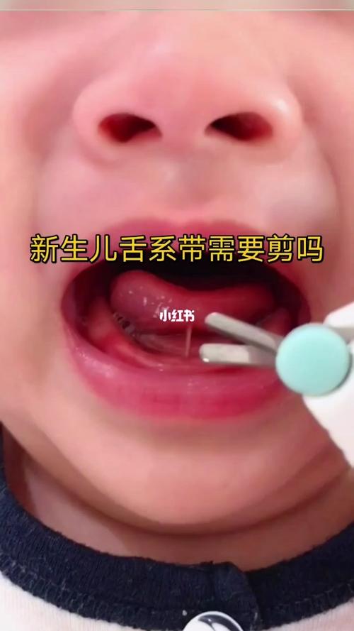 新生儿92可用手指将舌头抬起,若舌系带附着于舌尖处