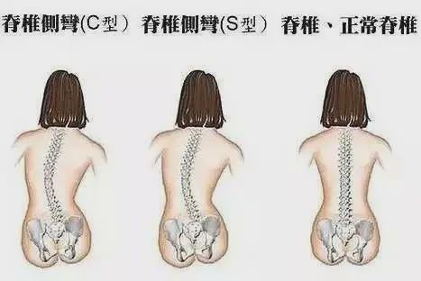 不仅仅是前后摊着,你还歪歪扭扭左右摊着,时间长了脊椎在正面也会变形