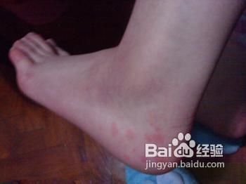 冻疮的治疗方法我有妙招