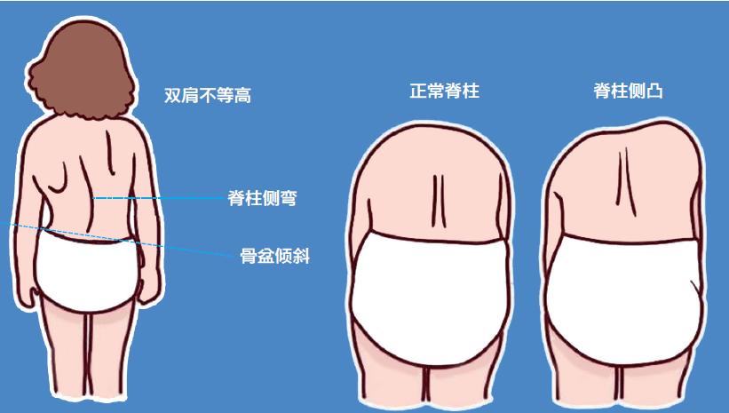 14岁女孩一年内脊柱弯成"c",直不起腰,剧烈活动后呼吸