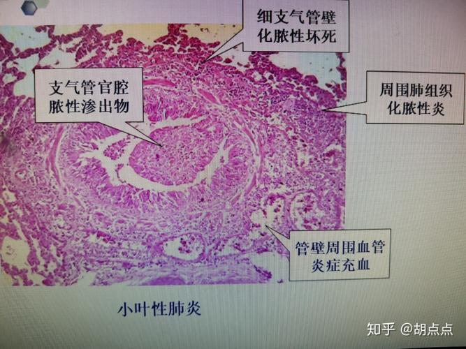 大叶性肺炎小叶性肺炎病理组织切片