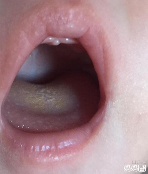母乳喂养宝宝两个月舌头上发黄