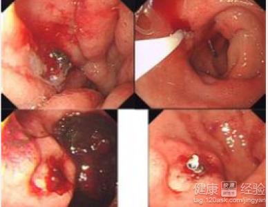 胃溃疡的自我疗法有哪些_最真实的经验分享_健康经验