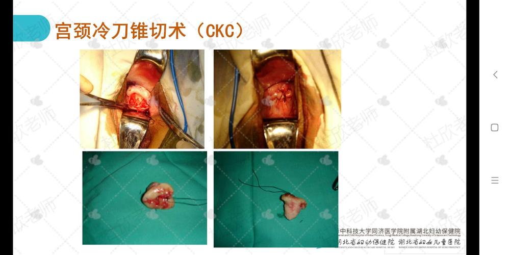 宫颈锥切术