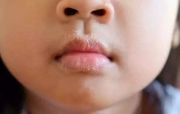 冬季宝宝嘴唇干燥脱皮,禁止宝宝常舔嘴唇,正确护理做