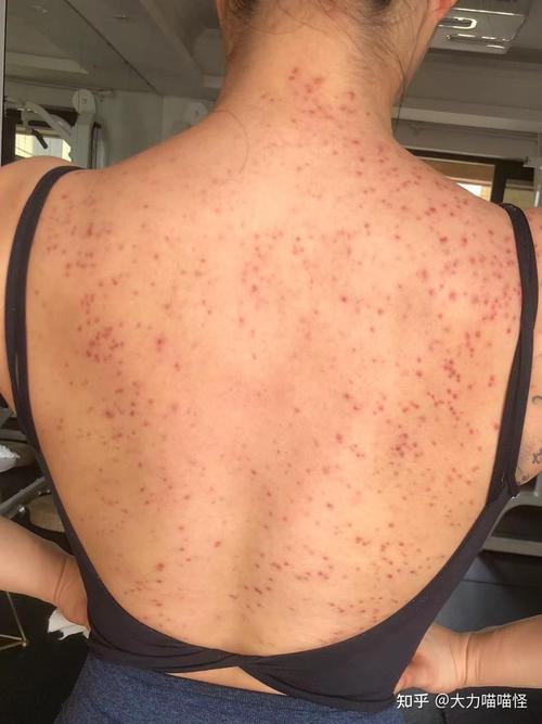 马拉色菌毛囊炎治疗记录