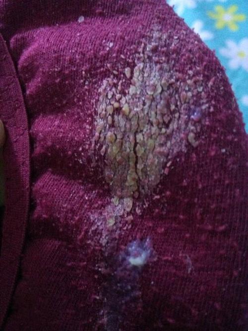 无其它症状就是白带多成粘白状,一天得换一次内裤