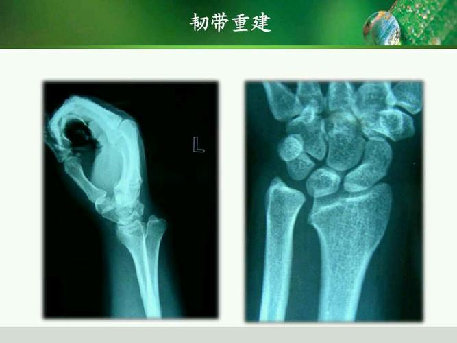 下尺桡关节损伤