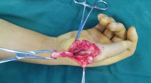 术中截骨术后"小六指"治疗要及时多指畸形的手术治疗时机,孙海滨主任