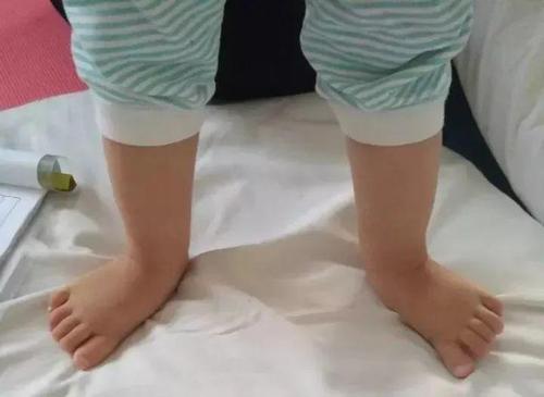 【儿康进行时】第52期//孩子有足外翻,应该怎么办?