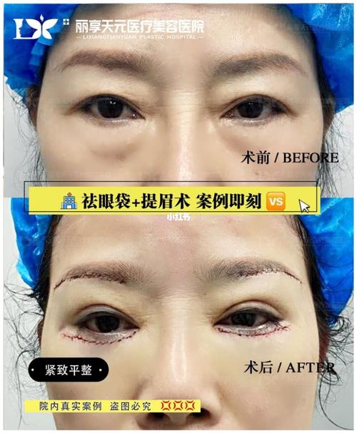 97提眉术77祛眼袋 术后90 术前眼皮,眼袋松弛下垂 术后紧致提拉