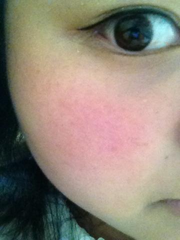 我脸上长得是癣吗为什么一到这个季节老反复啊