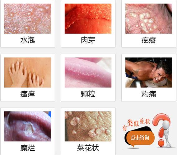 阴茎瘙痒长水泡怎么回事