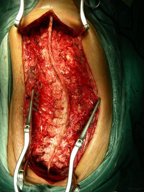 脊柱侧弯 术中影像