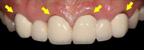 在深圳做烤瓷牙如何判断烤瓷牙做得好不好
